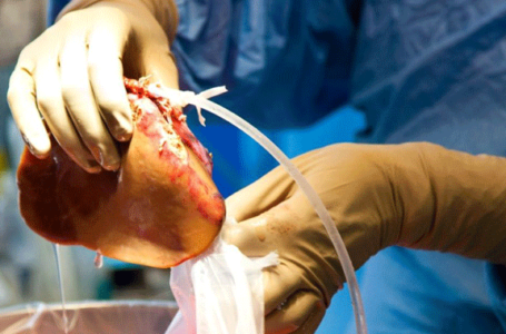 80% des médecins marocains souhaitent approfondir leur connaissance sur le don d’organe